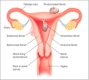 Ayurwoman fibroids in the uterus