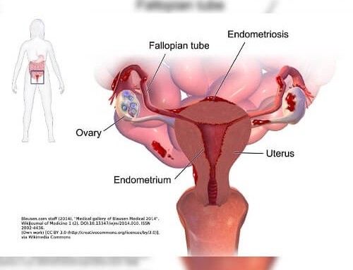 Endometriosis Treatment in Ayurveda